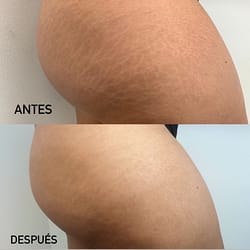 Micropigmentación para camuflaje de estrías